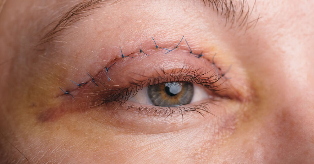 Blefaroplastia