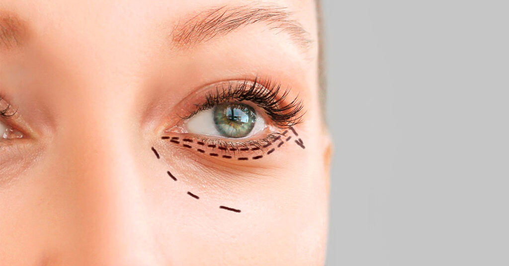 blefaroplastia